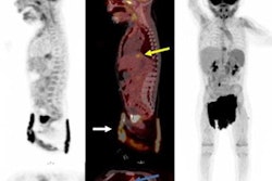 2022 06 24 23 16 3516 2022 06 27 Whole Body Pet Ct Child 20220624232923