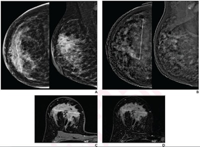 (A) Low-energy images from contrast-enhanced mammography (CEM) before neoadjuvant show a 60-mm architectural distortion in the central portion of the right breast. (B) Recombined images from pre-therapy CEM show marked background parenchymal enhancement; 90-mm non-mass regional enhancement (line) was described. (C) Axial fat-saturated T1-weighted unenhanced MR image shows a 70-mm hypointense irregular mass (line) with not circumscribed margins in the central portion of the right breast. (D) Axial fat-saturated T1-weighted post-contrast MR images show corresponding fast initial enhancement (line) with delayed plateau. All images are from a 41-year-old woman with invasive DCIS of the right breast. Images courtesy of the American Roentgen Ray Society and the American Journal of Roentgenology.