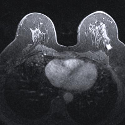 Diffusion-weighted imaging of breast begins to come of age