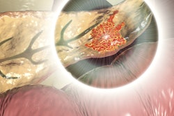 2020 05 28 22 36 8223 Cancer Pancreatic 400