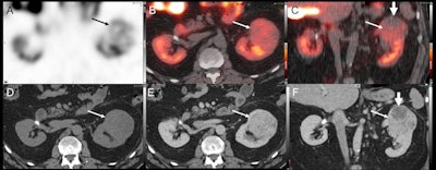 A 67-year-old man with previously diagnosed right renal cell carcinoma (RCC), post right partial nephrectomy presented with an enlarging left renal mass. Tc-99m sestamibi axial SPECT (A), and fused SPECT/CT (axial = B, coronal = C) images show a mass in the superior pole of the left kidney with its inferior part showing tracer avidity (thin arrow) and the superior part showing relative photopenia (thick arrow). It was diagnosed as a likely collision tumor on SPECT/CT with the inferior, tracer-avid region likely representing an oncocytic tumor and the superior, photopenic region likely representing a concerning RCC. Contrast-enhanced CT images (noncontrast = D, postcontrast nephrogenic phase axial = E, coronal = F) showed a solid heterogeneously enhancing left renal mass likely representing oncocytoma. The patient underwent left partial robot-assisted laparoscopic nephrectomy, and histopathology showed a collision tumor composed of clear cell RCC (rhabdoid differentiation, WHO/ISUP grade 4) and an eosinophilic variant of chromophobe RCC. Image courtesy of the Journal of Nuclear Medicine.