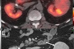 2022 07 05 16 03 0183 2022 07 06 Spect Ct Renal Cancer 20220705165615