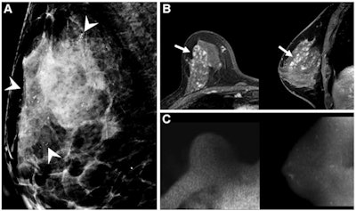 Images of a 46-year-old asymptomatic woman diagnosed with intermediate-grade ductal carcinoma in situ (DCIS) by 14-gauge needle biopsy. (A) Ultrasound image shows an irregular hypoechoic mass (arrow). Mammograms (not shown) showed heterogeneously dense breasts and did not show the lesion. (B) On preoperative contrast-enhanced axial (left) and sagittal (right) MRI scans, a 0.9-cm irregular enhanced mass was observed in the right lower inner breast (arrows). (C) Image from axial diffusion-weighted imaging (DWI) with b value of 1,200 sec/mm2 (left) and sagittal maximum intensity projection image (right) show high signal intensity (arrows) in the area corresponding to the enhanced lesion. Apparent diffusion coefficient (ADC) values were measured on the (D) fusion image of DWI and the ADC maps. Axial (left) and sagittal (right) fusion images were cross-referenced to ensure that the region of interest (ROI) was inside the tumor border and did not include the surrounding parenchyma. Images and caption courtesy of the RSNA.