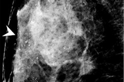 2022 07 06 19 26 4376 2022 07 07 Preop Mri Dcis Figure4 400