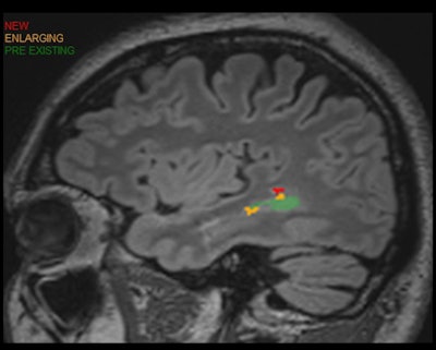 Patient with multiple sclerosis. Quantitative analysis enhances longitudinal analysis while increasing detection and efficiency. Image and caption courtesy of Dr. Laurence Tanenbaum and Icometrix.