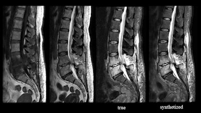 Osteomyelitis and discitis. Created using work-in-progress software from Subtle Medical, the synthetic image derived from the T1 and T2 images (left) emulates the true short tau inversion recovery (STIR) image. Images and caption courtesy of Dr. Laurence Tanenbaum and Subtle Medical.
