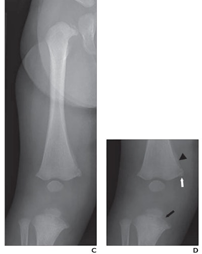 (C, D) a 4-month-old boy with knee classic metaphyseal lesions diagnosed with child abuse and with vitamin D deficiency (23.4 ng/mL). Child had multiple fractures other than knee CML, including multiple posterior rib fractures and fractures of the right fibula, left femur, and right first metatarsal. (C) Radiograph of proximal right lower extremity from skeletal survey. (D) Edited radiograph of the right knee shows distal right femoral medial healing corner fracture (white arrow), medial subperiosteal bone formation (arrowhead), and proximal tibial bucket-handle fracture (black arrow), all consistent with CML; radiograph shows no signs of rickets. All eight radiologists correctly interpreted radiograph as showing CML with moderate or high confidence.