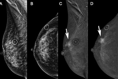 Diagnostic contrast-enhanced mammograms (CEM) were performed on a 58-year-old woman recalled from screening for possible right breast distortion. Low-energy images on (A) mediolateral oblique and (B) craniocaudal views are unremarkable and the distortion did not persist. Recombined images show incidental mass enhancement (arrow) in the upper outer right breast on (C) mediolateral oblique and (D) craniocaudal views. These are examples of two-view recombined-only findings. Images courtesy of RSNA.