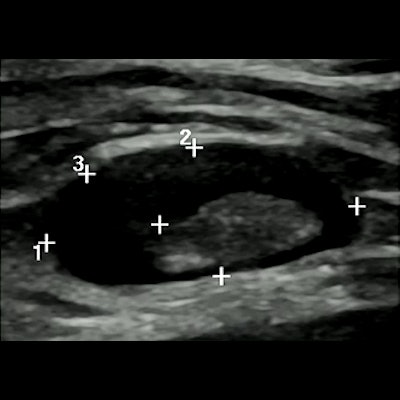 2022 07 15 00 51 3966 2022 07 13 Ecr Catonese Diffuse Cortical Thickening 400