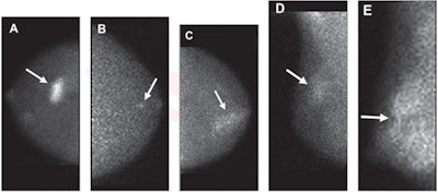 Molecular breast images show (A) mass (arrow) with marked intensity of uptake; (B) nonmass uptake (arrow) with focal distribution and mild intensity of uptake; (C) nonmass uptake (arrow) with segmental distribution and moderate intensity of uptake; (D) nonmass uptake (arrow) with regional distribution and mild intensity of uptake; and (E) nonmass uptake (arrow) with diffuse distribution and marked intensity of uptake. Image courtesy of the American Journal of Roentgenology.
