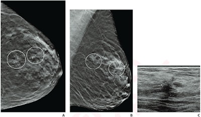 (A) Craniocaudal and (B) mediolateral oblique DBT images show two areas of architectural distortion in upper outer left breast (circles) that persisted on additional diagnostic tomosynthesis images (not shown). (C) Transverse grayscale ultrasound image of upper outer breast shows irregular hypoechoic mass with associated architectural distortion at 12:30 (arrow), corresponding to posterior architectural distortion. No ultrasound correlate was identified for anterior architectural distortion. Ultrasound-guided biopsy of posterior distortion revealed malignancy (invasive lobular carcinoma). Tomosynthesis-guided biopsy of anterior distortion yielded benign pathology (stromal fibrosis).