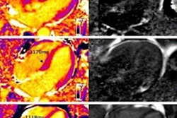 2022 07 28 21 26 4946 2022 07 29 Mri Cmr T1 Ecv Mapping 20220728210552