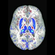 2022 08 01 22 47 9877 2022 08 02 Mri Iron Brain 400
