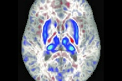 2022 08 01 22 47 9877 2022 08 02 Mri Iron Brain 400