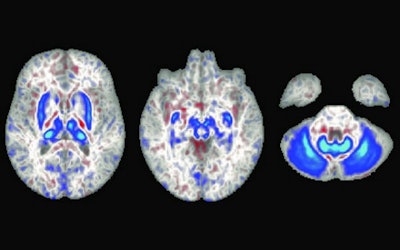In these brain scans, blue areas indicate regions with iron accumulation in individuals with two copies of the hemochromatosis risk gene. These regions also play a role in movement. Image courtesy of University of California, San Diego.