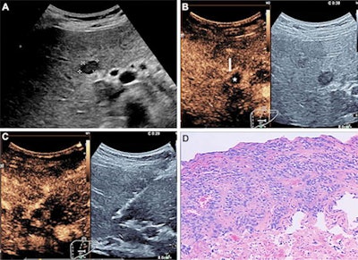 CEUS images show a change of the biopsy target area in a 54-year-old woman who presented with a two-week history of epigastric discomfort. A pancreatic mass and focal liver lesion were detected with standard ultrasound. (A) Ultrasound shows a hypoechogenic nodule with a 1.6-cm diameter in the left medial lobe. The center of the lesion was chosen as the biopsy target area at ultrasound. (B) CEUS scans show ringlike enhancement (arrow) of the focal liver lesion in the arterial phase. There was no enhancement in the center of the lesion (★), which indicated necrosis. (C) Biopsy was performed in the ringlike enhancement area with CEUS guidance in the arterial phase. (D) Pathologic analysis allowed for confirmation of an adenocarcinoma (Hematoxylin-eosin stain; original magnification, ×100). Image courtesy of the RSNA.