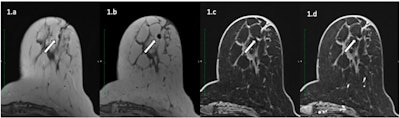 A 57-year-old patient with an invasive ductal carcinoma marked by an O-Twist metallic marker and treated with neoadjuvant chemotherapy underwent a presurgical MRI on a Siemens 3T with T2-weighted (a), T1-weighted (b), and 3D T1-weighted Dixon before (c) and after (d) contrast injection. Metallic marker is responsible for a hyposignal artifact with hyperintense peripheral halo. However, diagnostic confidence was 3 for both readers. Despite the relatively small size of the artifact, the small initial size of the tumor (7 mm) resulted in uncertainty in appreciations of both readers in the presence of the metallic marker artifact. The patient was considered rCR but histology revealed the presence of residual tumor. All figures courtesy of Dr. Matthias Hugot et al and European Journal of Radiology.