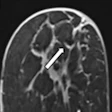 2022 08 03 21 49 1981 2022 08 03 Ejr Hugot Breast Mri Figure1 20220803213313