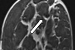 2022 08 03 21 49 1981 2022 08 03 Ejr Hugot Breast Mri Figure1 20220803213313