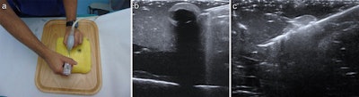 Researchers in Nottingham, England developed an ultrasound phantom that they say mimics soft breast tissue and allows for training in all practical aspects of performing ultrasound-guided biopsy including needle-probe position via A) visualizing the target and B) visualizing the needle passing through the target during a biopsy. Structures inside the phantom include pitted olives stuffed with raisins and balloons representing cysts. Images courtesy of the BIR.