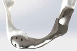 2022 08 09 17 54 8610 2022 08 09 Nci Titanium Jaw 400