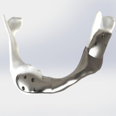 2022 08 09 17 54 8610 2022 08 09 Nci Titanium Jaw 400