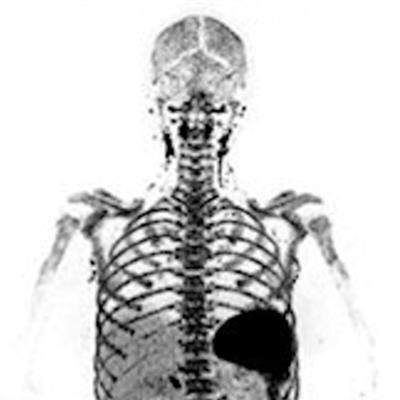 Use of total-body PET imaging to identify deep-tissue SARS-CoV-2