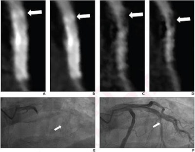 A 57-year-old man who underwent coronary CTA using two-breath-hold subtraction technique to assess patency of coronary artery stent. (A) Conventional hybrid interactive reconstruction (HIR) image and (B) conventional deep-learning reconstruction (DLR) image show blurred appearance of proximal aspect of stent (arrow). (C) Subtraction HIR image and (D) subtraction DLR image show discrete region of hypoattenuation at proximal aspect of stent (arrow). Both readers provided a diagnosis of in-stent restenosis only for subtraction HIR and subtraction DLR. Diagnostic confidence score for the four methods for reader 1 was 2, 2, 3, and 4, respectively, and for reader 2 was 1, 2, 3, and 3, respectively. Patient subsequently underwent invasive catheter angiography. Fluoroscopic imaging obtained (E) before and (F) after contrast media injection demonstrate in-stent restenosis of proximal aspect of stent (arrow). All images courtesy of the American Journal of Roentgenology.