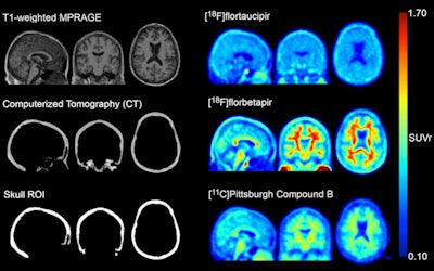 MR, CT, and standardized uptake value ratio (SUVr) images from an amyloid-negative participant with high radiotracer skull binding. Images are in MNI-152 space. Image courtesy of the Journal of Nuclear Medicine.