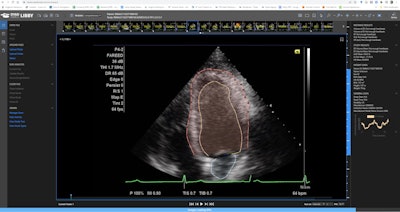 Dyad Medical's Echo:Prio AI-based echocardiography analysis software. Image courtesy of Dyad.