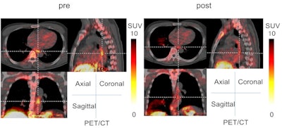 A grade 3 case (T1bN0M0, stage I) of esophageal cancer showing carbon-11 methionine radiotracer uptake on PET/CT before and three weeks after carbon ion radiotherapy. Image courtesy of Scientific Reports.