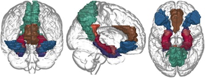 Social anxiety-related brain regions included in the current study: orbitofrontal cortex (blue), anterior cingulate cortex (brown), posterior cingulate cortex (orange), precuneus (green), hippocampus (red), parahippocampal gyrus (purple), and amygdala (pink). Images and caption courtesy of Scientific Reports through CC BY 4.0 International License.