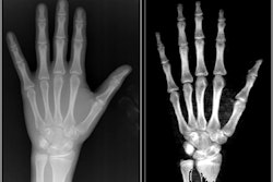 2022 08 18 21 33 9281 2022 08 19 Bone Age X Ray 400