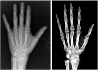 An example of an x-ray image (left) and DEXA image (right) of nondominant hand used in the study. The images are from a male patient (chronological age: 15.4 years; bone age by x-ray, 15.5 years). Image courtesy of the Journal of Clinical Densitometry.