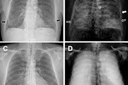 2022 08 19 21 04 3105 2022 08 22 Dark Field X Ray Emphysema Case 20220819212812