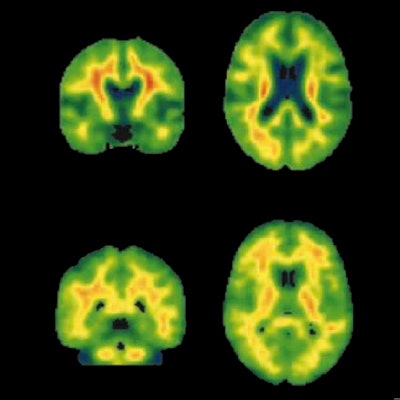 2022 08 19 23 10 0987 2022 08 22 Early Amyloid Binding 400