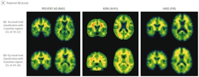 Illustrative examples of participants with regional amyloid PET radiotracer uptake. In the PREVENT-AD study cohort, the two and four regions positive were precuneus and posterior cingulate, plus rostral anterior cingulate and medial orbitofrontal. In the ADNI study cohort, the two regions were rostral middle frontal and inferior parietal, and the four were the inferior parietal, precuneus, posterior cingulate, and medial orbitofrontal. In the HABS cohort, the regions were rostral anterior cingulate and medial orbitofrontal, plus rostral middle frontal and superior frontal. Image courtesy of JAMA Neurology.