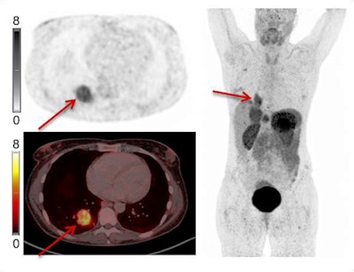 Example of Ga-68 NODAGA-E[c(RGDyK)]2 PET/CT. Transaxial PET and fused PET/CT and maximum intensity projection with color bars (unit: SUV). Patient with lung neuroendocrine tumor grade 2 (Ki67 15%) with liver and bone metastases. Arrow at primary tumor. Image courtesy of the Journal of Nuclear Medicine.
