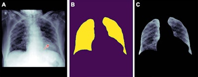 Example of how improper feature removal from imaging data may lead to bias. (A) Chest radiograph in a male patient with pneumonia. (B) Segmentation mask for the lung, generated using a deep-learning model. (C) Chest radiograph is cropped based on the segmentation mask. If the cropped chest radiograph is fed to a subsequent classifier for detecting consolidations, the consolidation that is located behind the heart will be missed (arrow, A). This occurs because primary feature removal using the segmentation model was not valid and unnecessarily removed the portion of the lung located behind the heart. Images courtesy of the RSNA.