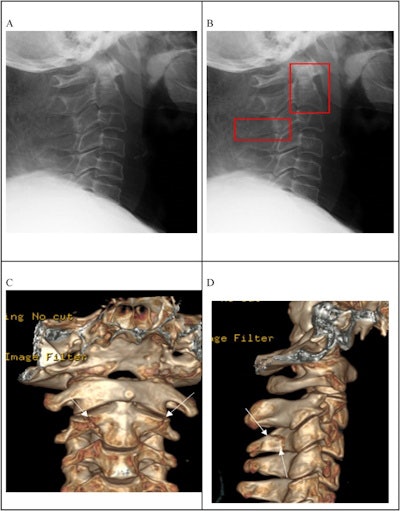 Lateral cervical radiograph with a CT report of fracture at C2 vertebral body and fracture of C3 transverse process. The fractures are not clearly visible on the radiograph (A) and were labeled at the relevant anatomy (B). (C) and (D) are a 3D CT scan of the patient showing fractures at C2 vertebral body and C3 spinous process. Image courtesy of Heliyon.