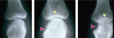 Representative radiographs showing joints without disease and joints with mild and severe damage due to rheumatoid arthritis. Red arrows indicate areas of erosion; yellow arrows, areas with joint space narrowing. Image courtesy of JAMA Open Network.
