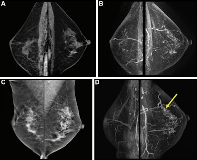 Postoperative surveillance images in a 54-year-old woman who had undergone right breast-conserving surgery and postoperative radiation therapy two years prior for stage III hormone receptor-positive invasive ductal carcinoma. She had completed adjuvant chemotherapy and was on endocrine therapy. She had no family history of breast cancer and had not been tested for the BRCA1/BRCA2 genes. (A) Bilateral sagittal contrast-enhanced T1-weighted and (B) maximum intensity projection images from baseline surveillance breast MRI show asymmetric moderate background parenchymal enhancement in the left breast. (C) Surveillance mammograms acquired within six months of surveillance breast MRI show heterogeneously dense breasts. (D) Subsequent surveillance breast MRI scans acquired two years after baseline surveillance breast MRI show a small irregular enhancing mass in the left upper breast (arrow). Biopsy and surgical pathologic examination revealed a 0.8-cm ductal carcinoma in situ.
