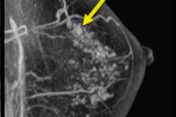 2022 08 30 17 47 8872 2022 08 30 Breast Mri Second Cancer Figure3 400
