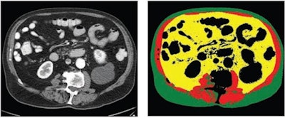 70-year-old white male patient with weight of 79.8 kg, body mass index (BMI) of 29.3, and low cardiovascular risk factors (nonsmoker, no diabetes diagnosis, blood pressure of 120/78). (Left) Axial CT image at level of L3 vertebral body. (Right) Matching automated segmentation label map. Visceral fat area z score is 1.41, corresponding to the 92nd percentile. Patient experienced both subsequent myocardial infarction and stroke. Images and caption courtesy of the American Journal of Roentgenology.