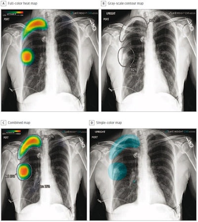 The different display modes of AI output: Shown are the color heat map (A), grayscale contour map (B), combined map (C), and single-color map (D). Image courtesy of JAMA Network Open.
