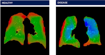 Lung scans depicting healthy subjects and lungs of a veteran with biopsy-confirmed constrictive bronchiolitis, as processed by 4DMedical's XV LVAS software. Single slices of fluoroscopic scans from the Vanderbilt 'burn pit' clinical trial from a healthy subject (left) and from a veteran exposed to burn pits (right) with biopsy-confirmed constrictive bronchiolitis. The green in the image on the left represents average levels of ventilation, while the image on the right shows significant regions of both low (red) and high (blue) ventilation. Image courtesy of 4DMedical.