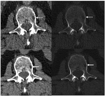 Reference protocol (top) and evaluated protocol (bottom) images in a 74-year-old man with multiple myeloma. Soft-tissue reconstruction is shown (left side; window width, 400; window level, 40), whereas the right column is the bone reconstruction (right side; window width, 3700; window level, 600). A lytic bone lesion in the L3 vertebral body is more conspicuous on the noncontrast-enhanced axial photon-counting CT reconstruction images (bottom; solid arrows) compared with the noncontrast-enhanced axial energy-integrating detector CT reconstruction images (top; dashed arrows). Image and caption courtesy of the RSNA.
