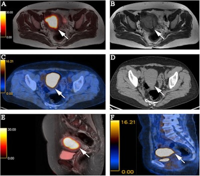 FIGO stage II pathologically confirmed moderately differentiated adenocarcinoma in a 57-year-old female patient. (A) Axial PET/MR images. (B) Axial MR T2-weighted images. (C) Axial PET/CT images. (D) Axial CT images. (E) Sagittal PET/MR images. (F) Sagittal PET/CT images. PET/MRI and MRI show the endometrial carcinoma invading the cervical stroma. PET/CT also shows the endometrial carcinoma invading the cervical stroma, yet the extension of the tumor is difficult to determine. The PET/MRI and PET/CT staging were consistent with the pathological stage, namely FIGO stage II. The white arrow indicates endometrial carcinoma. Image courtesy of BMC Cancer.