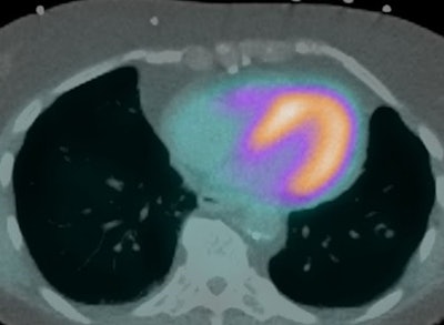 A figure from the new guidelines showing proper co-registration of a PET image onto a CT attenuation correction scan. Image courtesy of the ASNC.