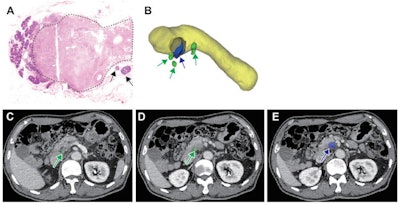 AI bests rads for predicting pancreatic cancer metastasis